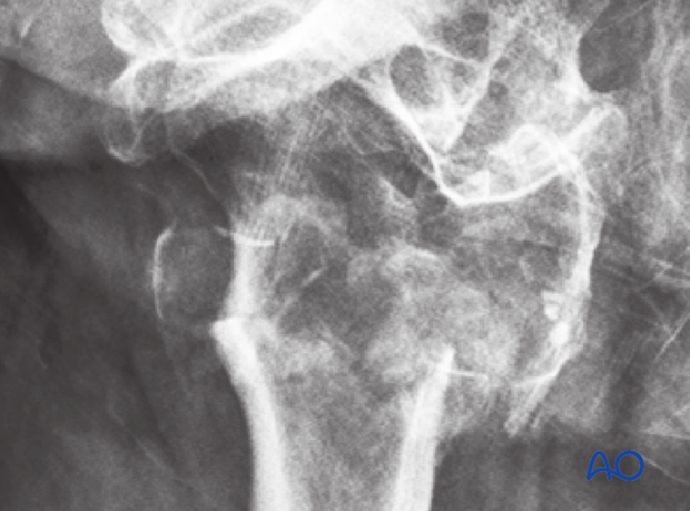 X-ray of a multifragmentary intertrochanteric fracture