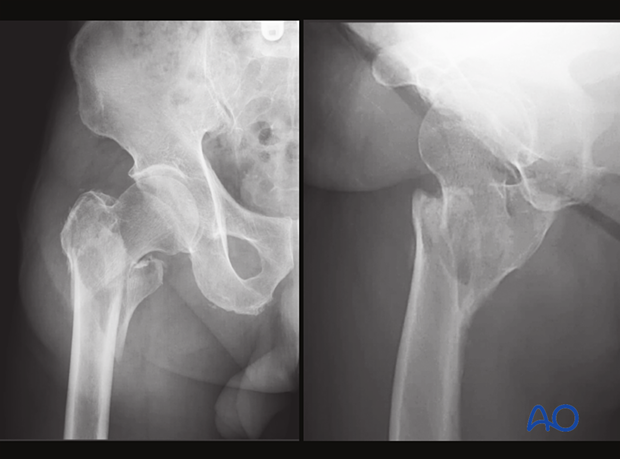 Plain AP and lateral x-rays of a multifragmentary intertrochanteric fracture
