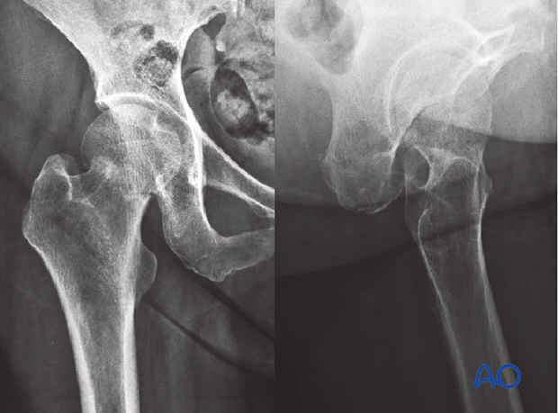 AP and lateral x-ray of an impacted femoral neck fracture