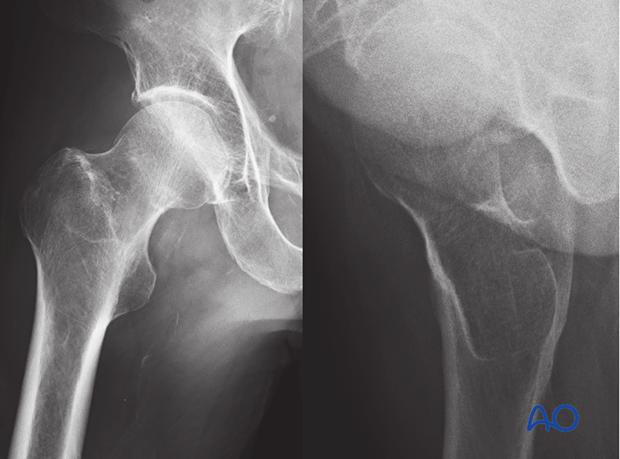 AP and lateral x-ray of an undisplaced femoral neck fracture