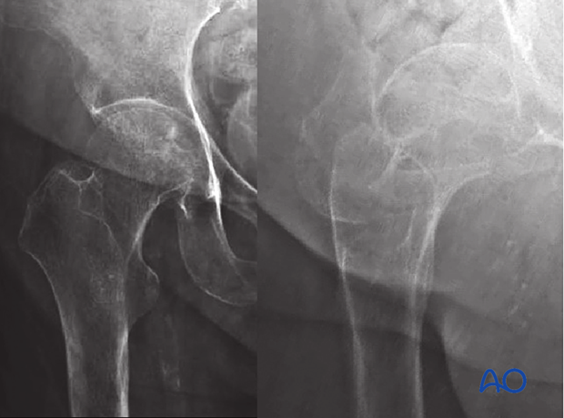An undisplaced fracture may also be referred to as occult fracture as it is not well visible in an x-ray and may not be diagnosed correctly.