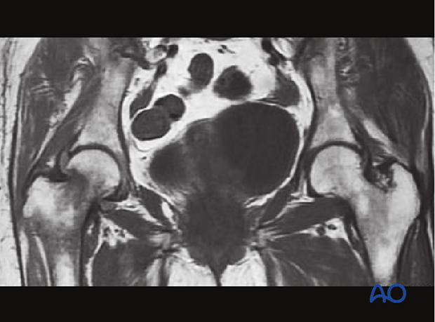 MRI image of an undisplaced femoral neck fracture