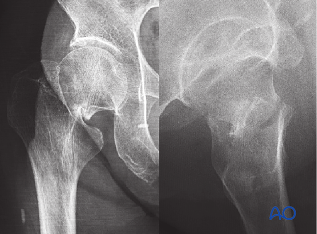 x-rays of a displaced subcapital femoral neck fracture