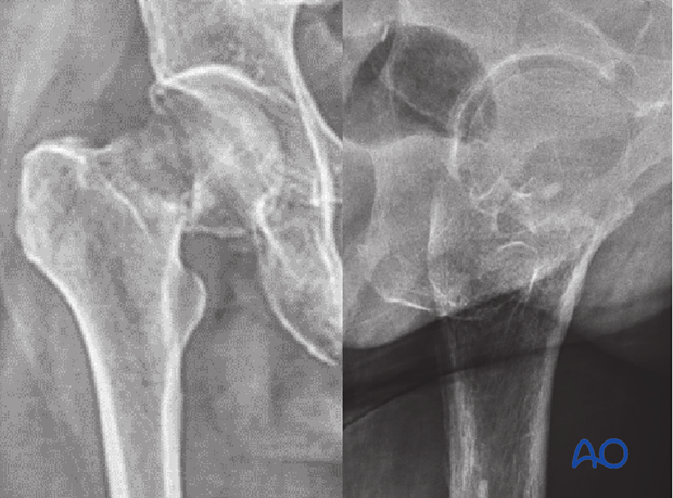 X-rays of a simple transcervical femoral neck fracture