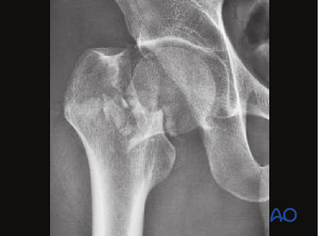AP x-ray of a multifragmentary transcervical fracture