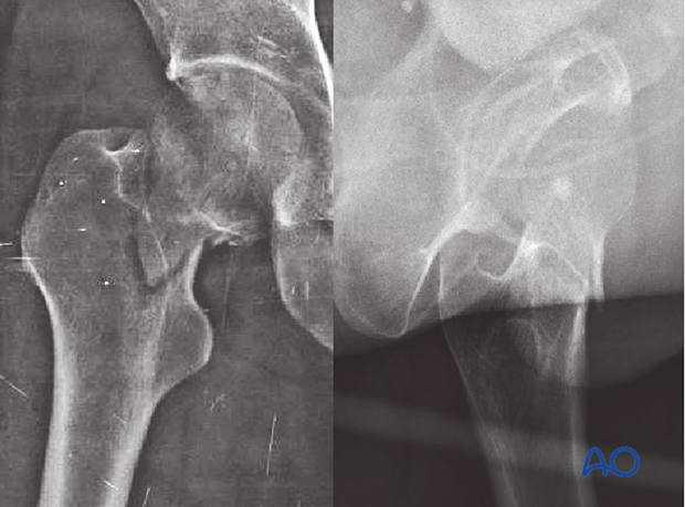 X-ray of a transcervical shear fracture of the femoral neck