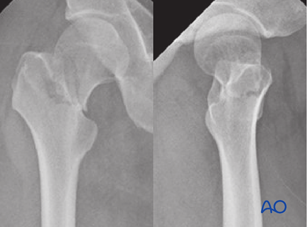X-rays of a basicervical femoral neck fracture