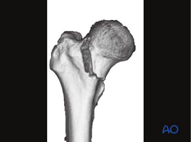 3-D CT view of a basicervical femoral neck fracture
