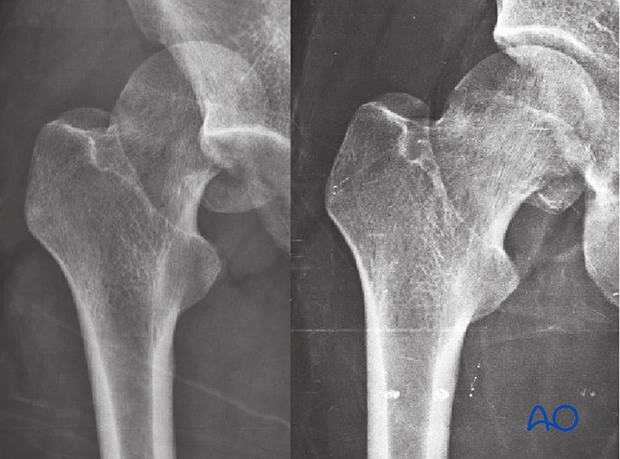X-rays of a split fracture of the femoral head
