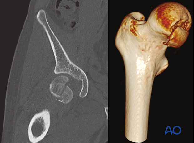 CT images of a split fracture of the femoral head