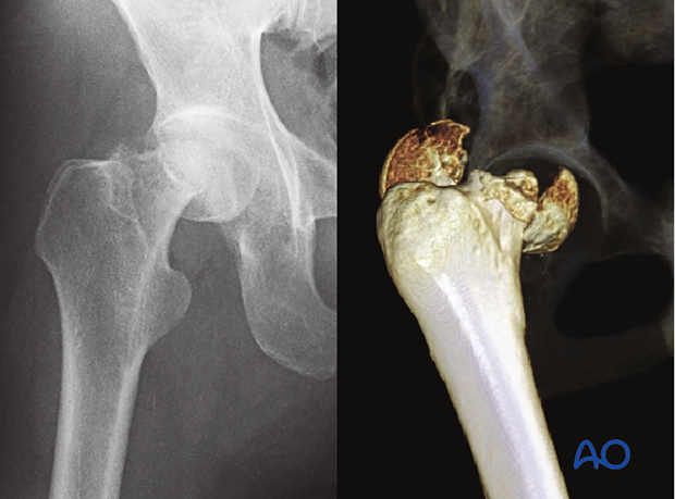 X-ray and 3-D CT view of a combined fracture of the femoral head and neck