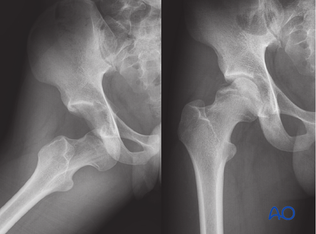 X-rays of a depression fracture of the femoral head