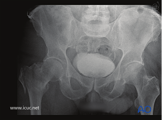 AP pelvis x-ray of multifragmentary proximal femoral fracture