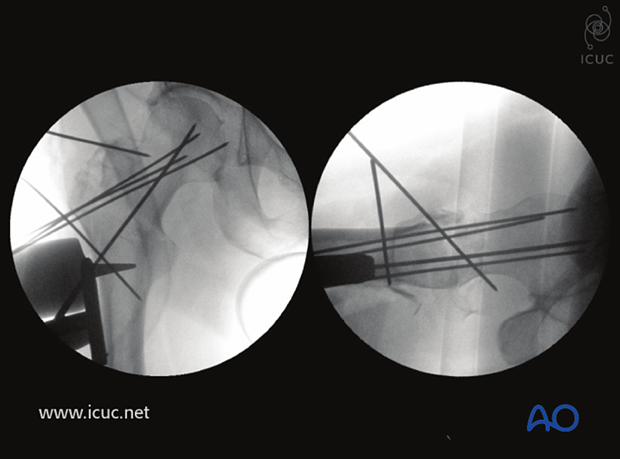 Careful reconstruction with K-wires holding multiple fragments reduced, and with a DHS guide wire placed centrally in the femoral head in both views