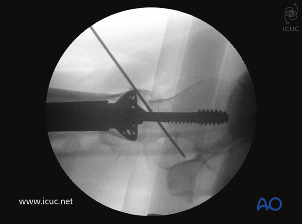 Intraoperative axial view with excellent reduction of the multifragmentary proximal femur fracture with trochanteric stabilization plate in place