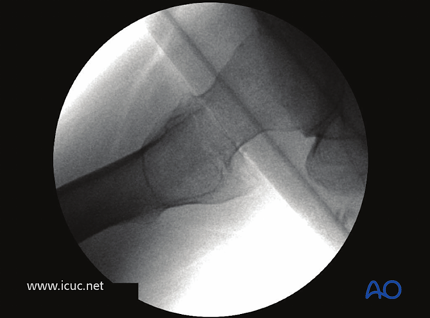 Initial images in the operating room with the patient in traction showing the fracture reduced