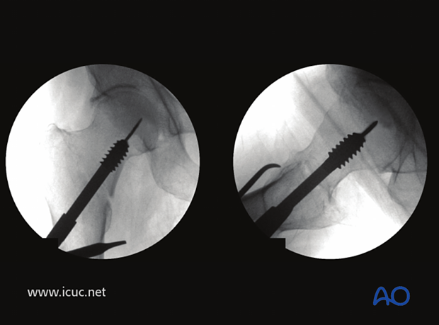 The hip screw is inserted under image intensifier control.