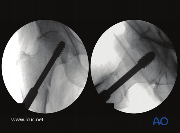 Postoperative image showing hip screw placed on both views with good tip apex position. (Tip apex distance in this instance is about 10 mm).