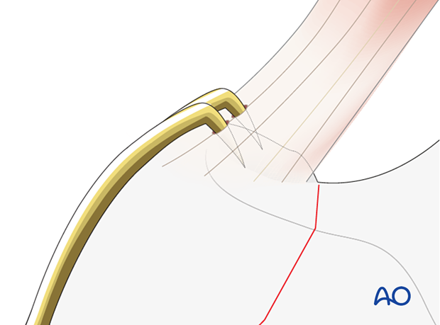 Stab incisions through the gluteus medius to place the two hooks into the tip of the greater trochanter