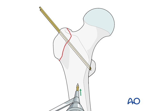 Creating a hole in the lateral cortex of the intact femoral diaphysis for tension band wiring in isolated greater trochanteric fractures