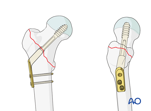 Fixation of a pertrochanteric fracture with a sliding hip screw
