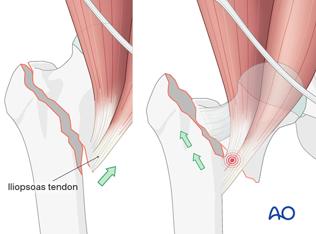 Pull of the iliopsoas muscle on the proximal fragment (left illustration) and superolateral displacement of the shaft after high-energy trauma (right illustration) in pertrochanteric fractures