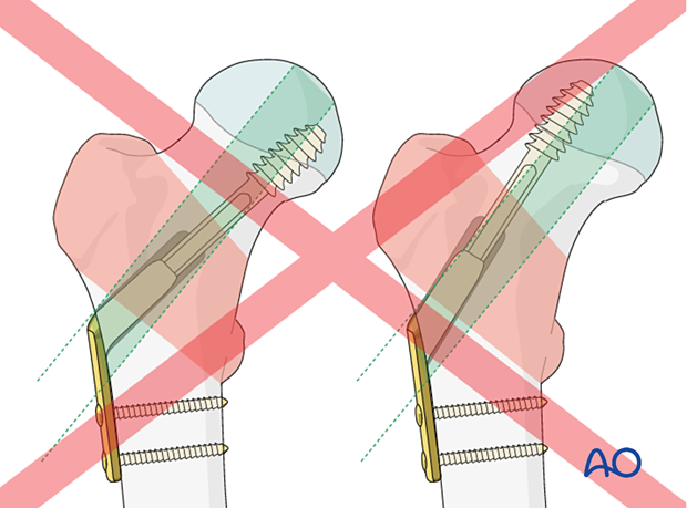 Incorrect lag screw positioning for the fixation of pertrochanteric fractures with a sliding hip screw