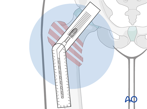 Measuring the femoral neck-shaft angle from the AP view after reduction for selection of the correct sliding hip screw implant