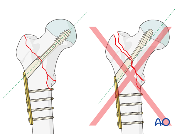 Correct and incorrect implant angle of a sliding hip screw