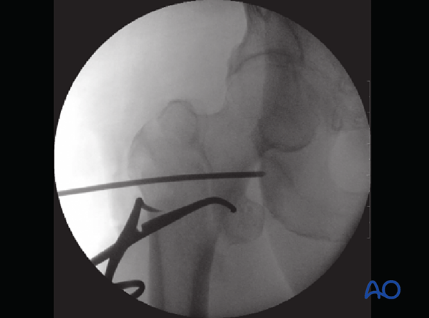 AP view of trochanteric fracture reduction with pointed reduction forceps and K-wires for preliminary stabilization