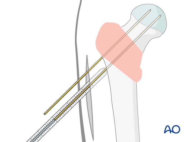 Determining the lag-screw length for sliding hip screw application