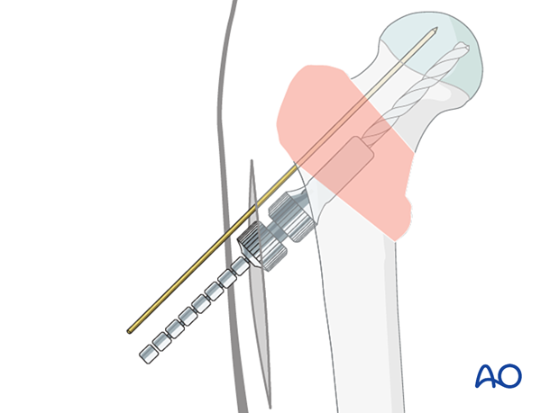 Reaming for insertion of a sliding hip screw with the dedicated triple reamer