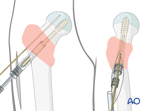 Insertion of the femoral neck screw for application of a sliding hip screw