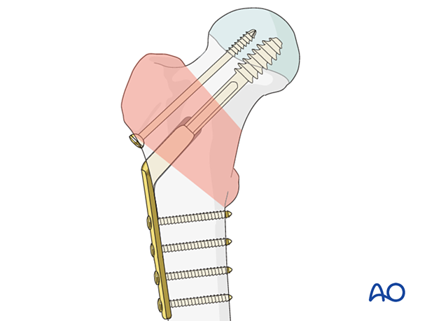 Fixation of a pertrochanteric fracture with a sliding hip screw and antirotation screw