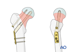 Fixation of a femoral neck fracture with a sliding hip screw and antirotation screw