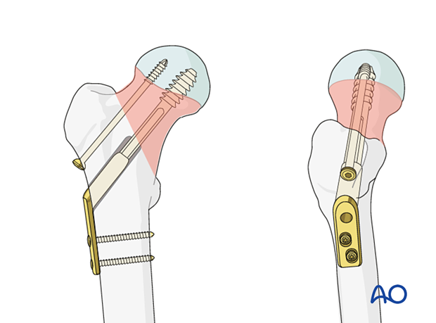 Fixation of a femoral neck fracture with a sliding hip screw