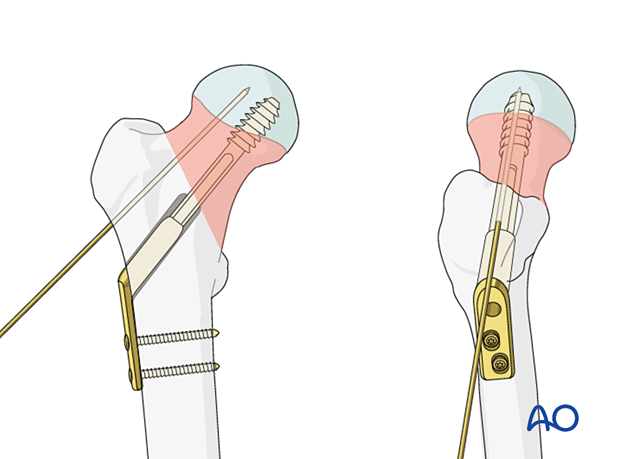 Fixation of the sliding hip screw plate to the femoral shaft with two cortical screws