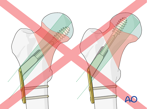 Incorrect lag screw positioning for the fixation of femoral neck fractures with a sliding hip screw