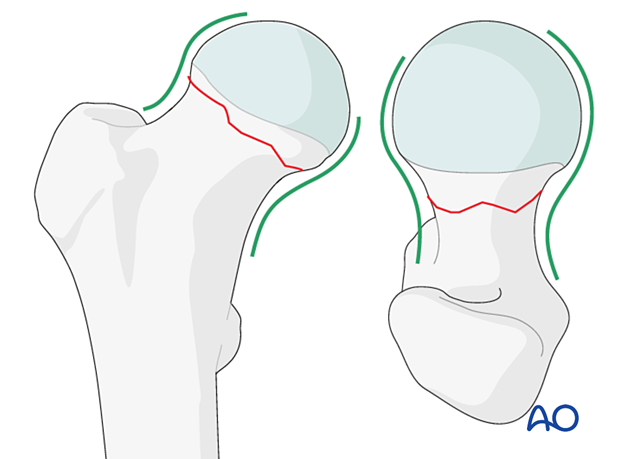 Patterns in AP and axial view for acceptable reduction of femoral neck fractures