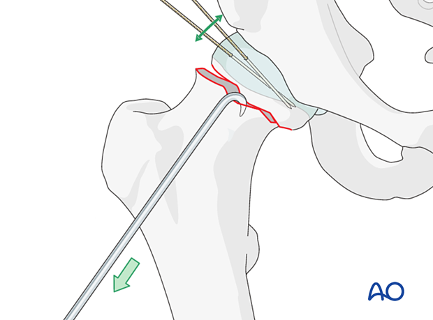 For reduction of femoral neck fractures, head and neck may be manipulated with hooks or K-wires acting as joysticks.
