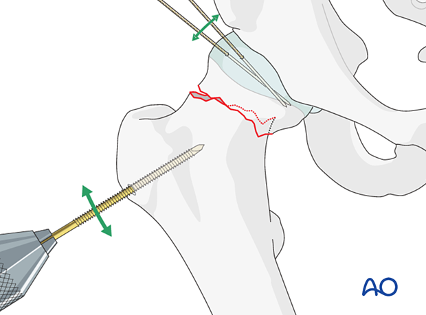 For reduction of femoral neck fractures, the distal fragment may be manipulated with a Schanz screw and the head and neck fragment with hooks or K-wires acting as joysticks.