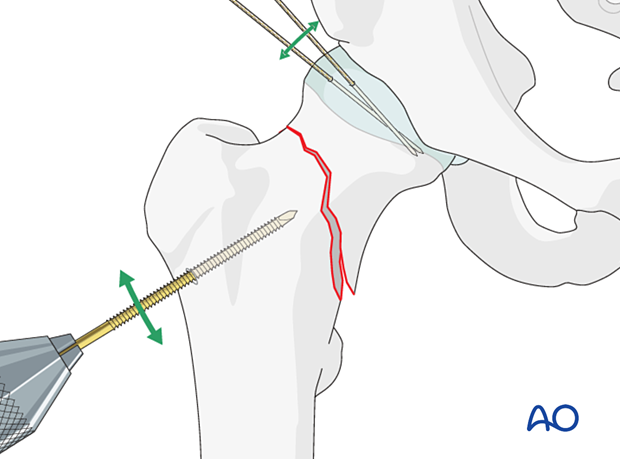 For reduction of femoral neck fractures, the distal fragment may be manipulated with a Schanz screw and the head and neck fragment with hooks or K-wires acting as joysticks.