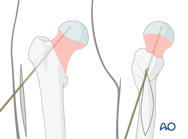 Antirotation wire to avoid rotational displacement of femoral neck fractures during sliding hip screw insertion