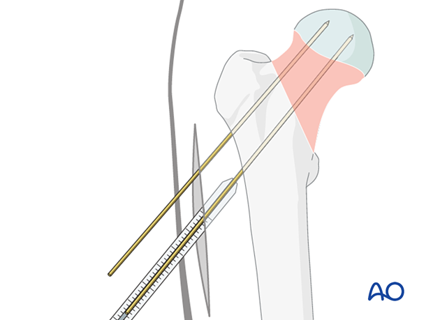 Determining the lag-screw length for sliding hip screw application