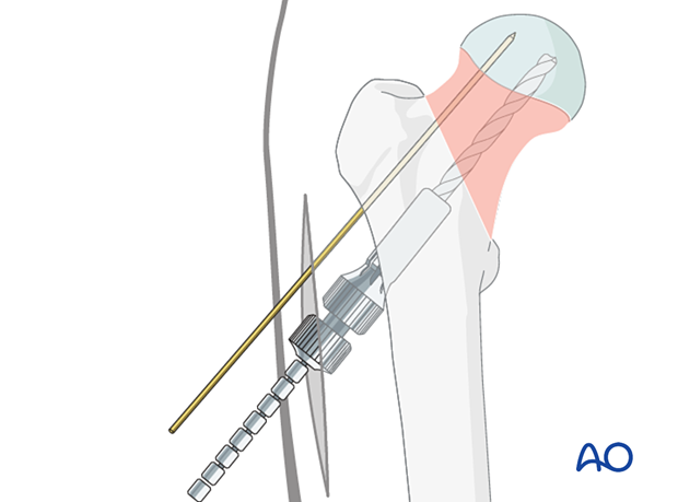 Reaming for insertion of a sliding hip screw with the dedicated triple reamer