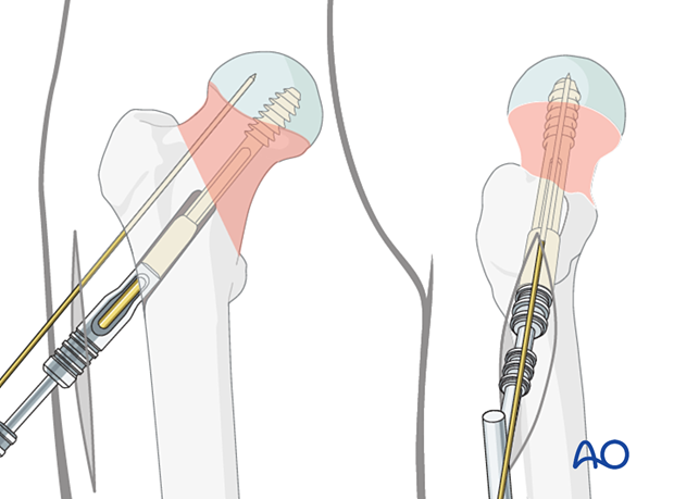 Insertion of the femoral neck screw for application of a sliding hip screw