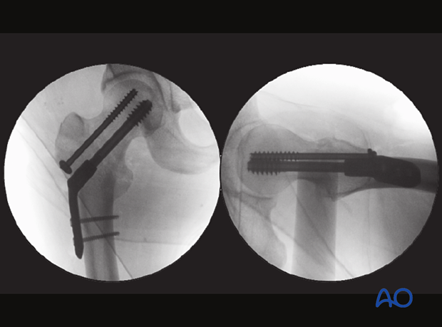 AP and lateral/axial view of a femoral neck fracture fixed with a sliding hip screw and antirotation screw