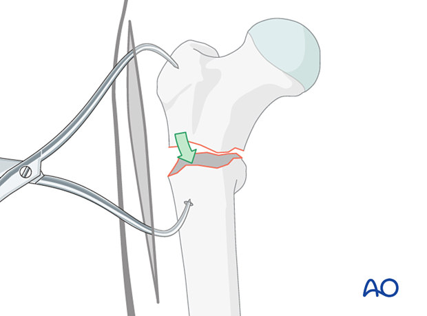 Direct reduction of an intertrochanteric fracture with pointed reduction forceps