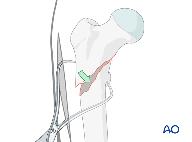 Direct reduction of an intertrochanteric fracture with pointed reduction forceps