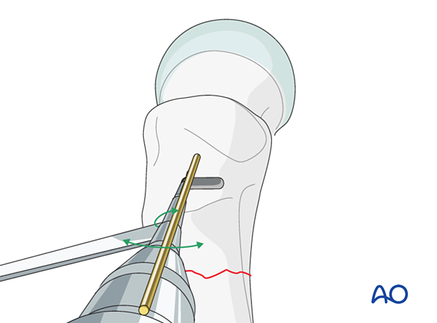 Opening the lateral cortex of the trochanter for fixation of an intertrochanteric fracture with an angled blade plate